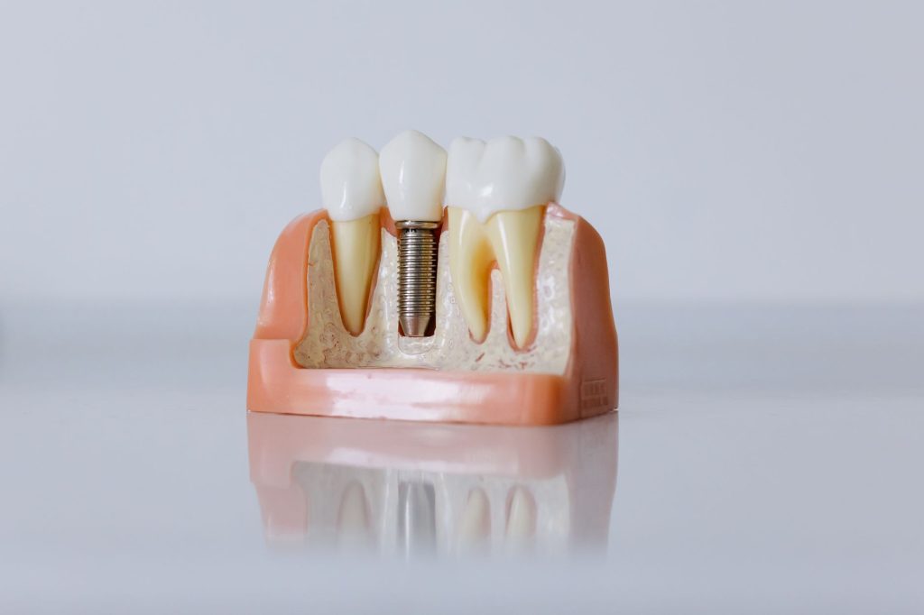 Is It Worth Going to Turkey for Dental Implants? Overview of Implant Installation