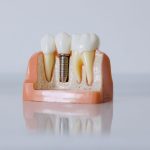 Is It Worth Going to Turkey for Dental Implants? Overview of Implant Installation