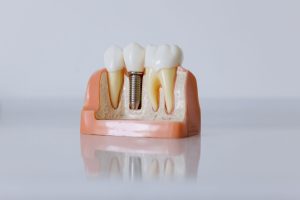 Is It Worth Going to Turkey for Dental Implants? Overview of Implant Installation